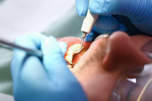 Best Knocked-Out Tooth (Avulsed Tooth) Treatment in Sanger, CA